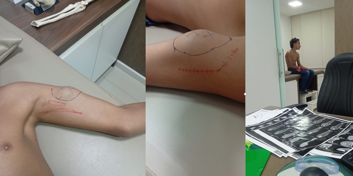 Festa Beneficente em Rio Novo do Sul: Comunidade se Une para Ajudar Adolescente em Cirurgia Delicada